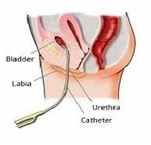 Catheter-Female