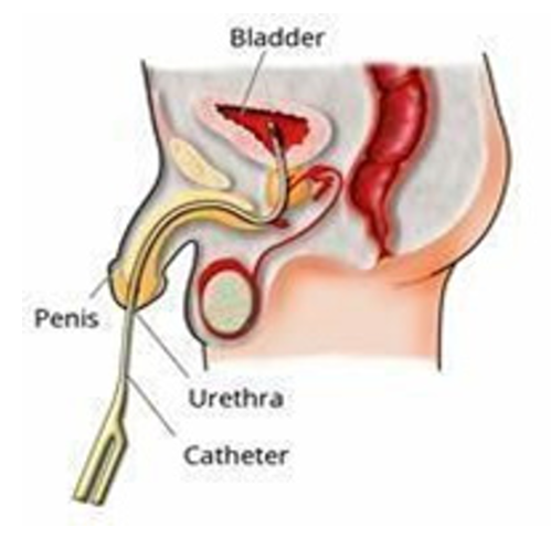 Catheter-Male